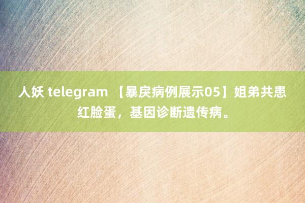 人妖 telegram 【暴戾病例展示05】姐弟共患红脸蛋，基因诊断遗传病。